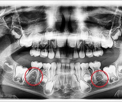 missing-premolars